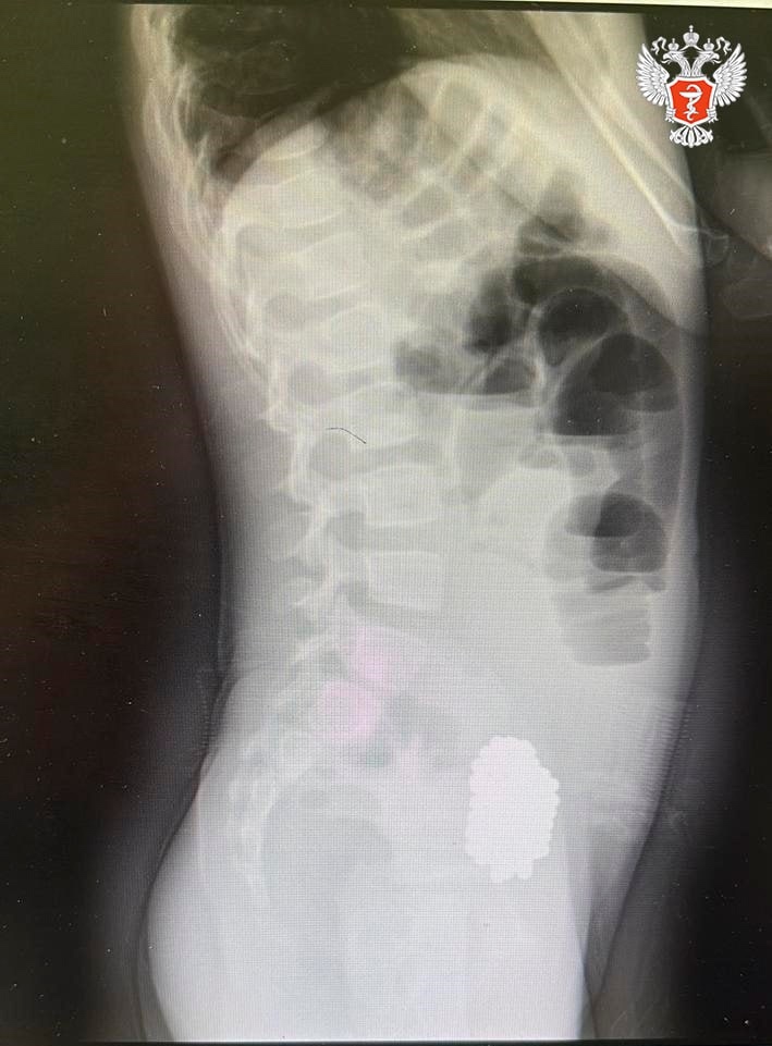 Волгоградские врачи спасли ребенка, который проглотил 134 магнитных шарика