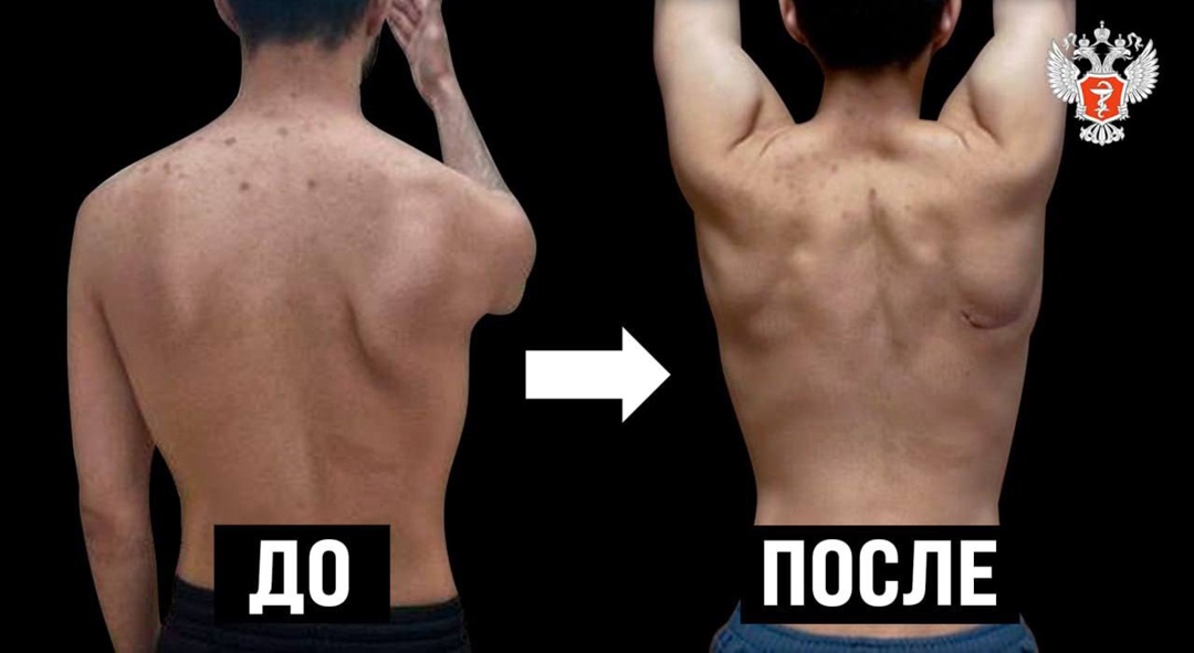 Специалисты федерального центра Минздрава России вернули к нормальной жизни пациента с редким заболеванием плечевого пояса