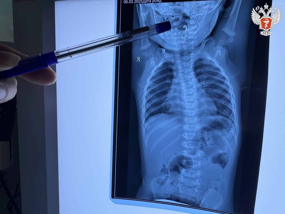 Приморские врачи спасли 7-месячного ребенка, который проглотил раскрытую булавку