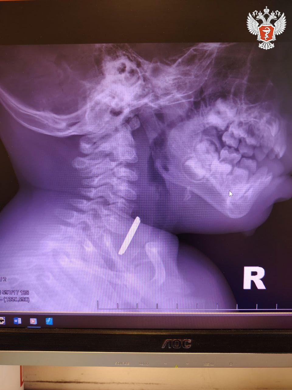 Ханты-Мансийские врачи спасли ребенка, проглотившего батарейку