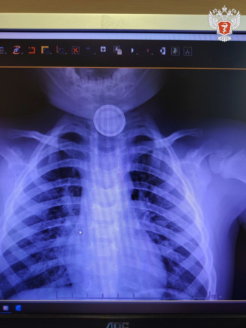 Ханты-Мансийские врачи спасли ребенка, проглотившего батарейку