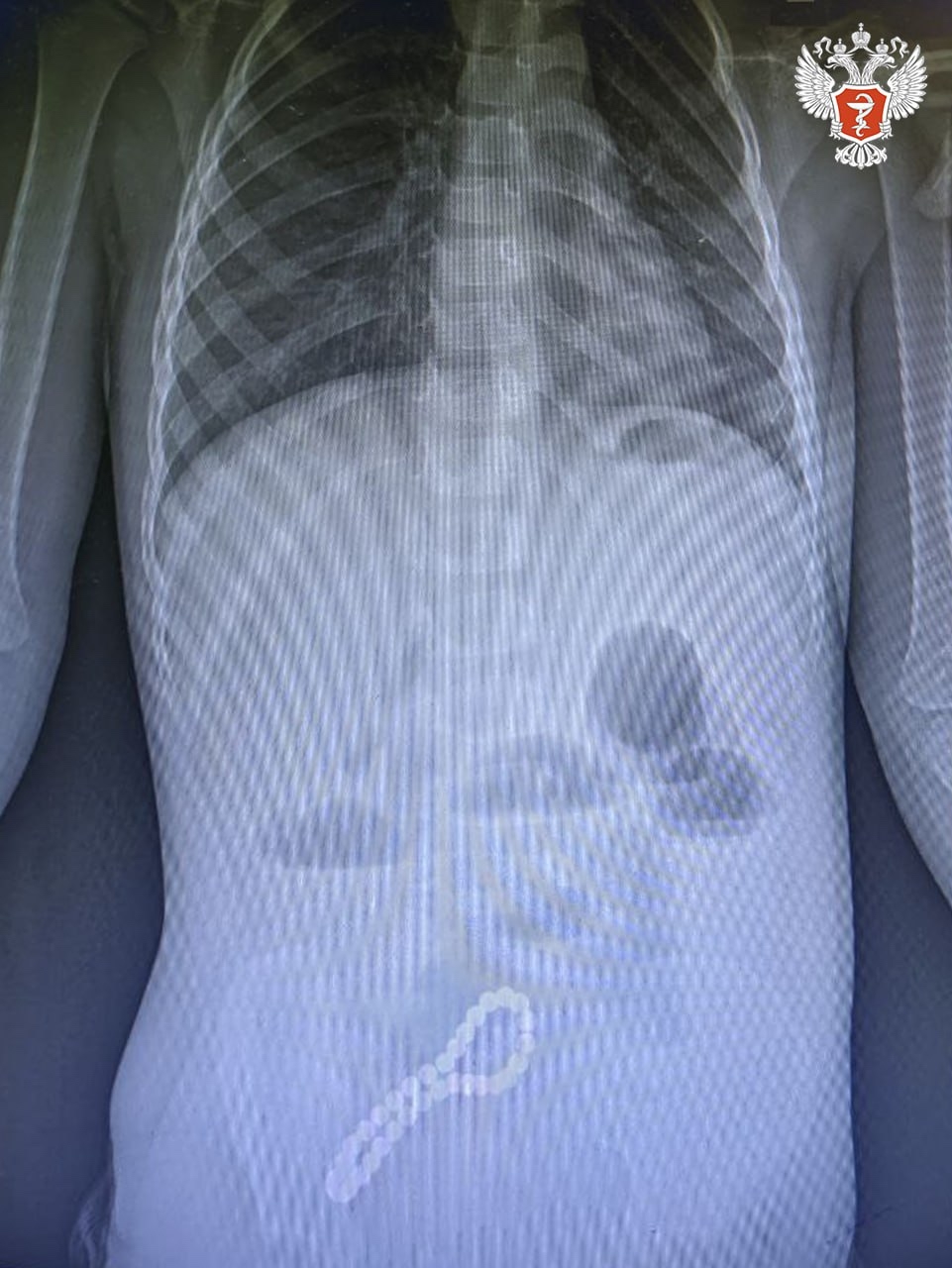Рязанские врачи спасли малыша, проглотившего магнитный браслет
