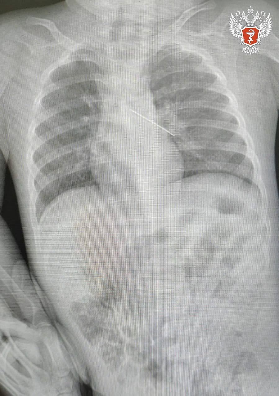 Ханты-Мансийские врачи спасли малыша, проглотившего булавку