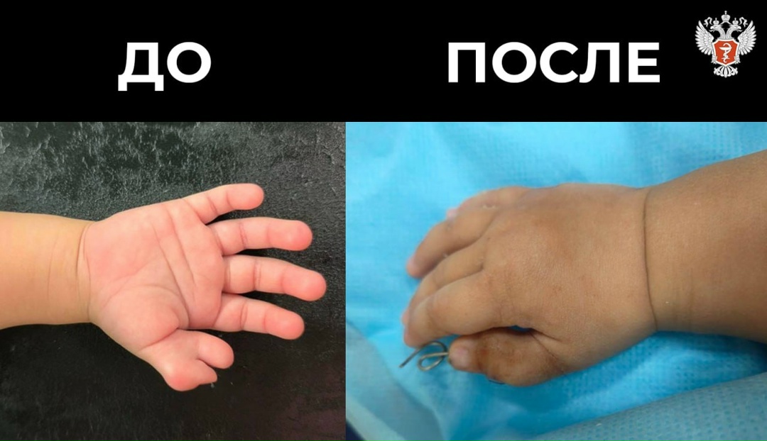 Подмосковные врачи избавили ребенка от шестого пальца