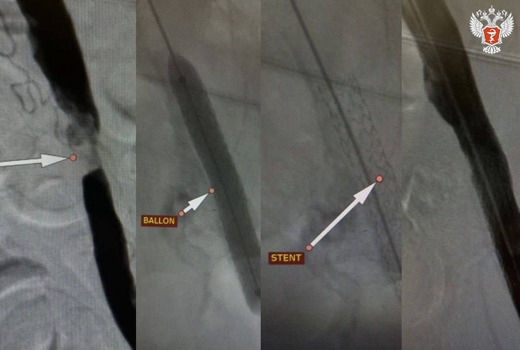 Волгоградские врачи сохранили ногу пациенту