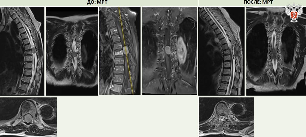 В федеральном центре Минздрава России поставили на ноги парализованную пациентку