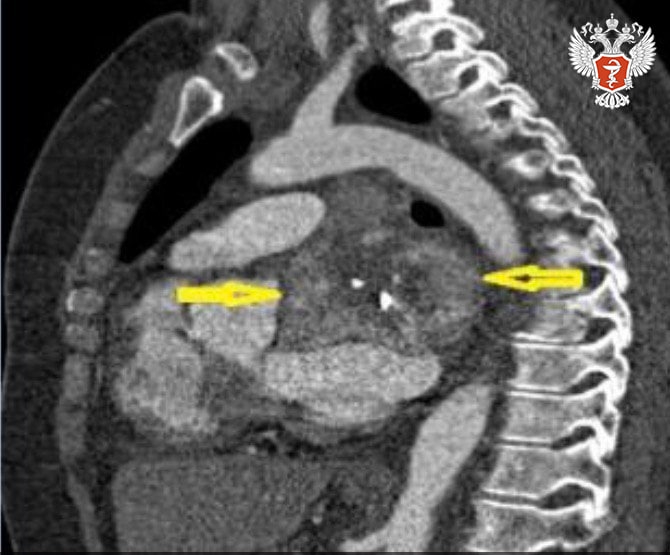 Специалисты НМИЦ онкологии им. Н.Н. Блохина Минздрава России провели аутотрансплантацию сердца при опухоли предсердия