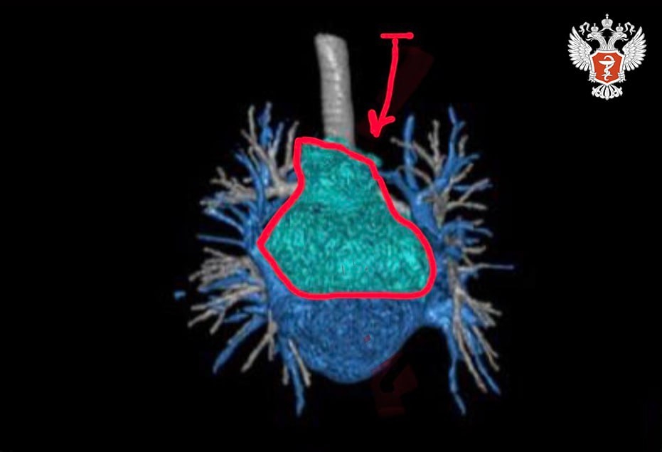 Специалисты НМИЦ онкологии им. Н.Н. Блохина Минздрава России провели аутотрансплантацию сердца при опухоли предсердия