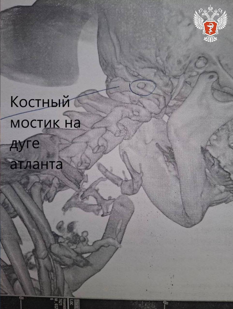 Врачи Запорожской области спасли мужчину с аномалией Киммерли