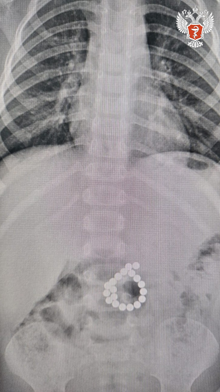 Ханты-Мансийские врачи спасли двухлетнего ребенка, проглотившего 19 магнитов
