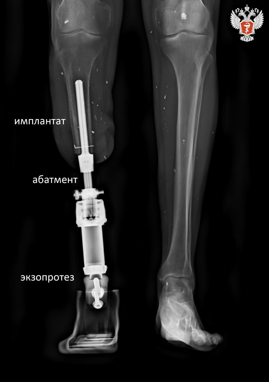 Специалисты НМИЦ травматологии и ортопедии им. Р.Р. Вредена Минздрава России выполнили первую в стране операцию по протезированию методом остеоинтеграции