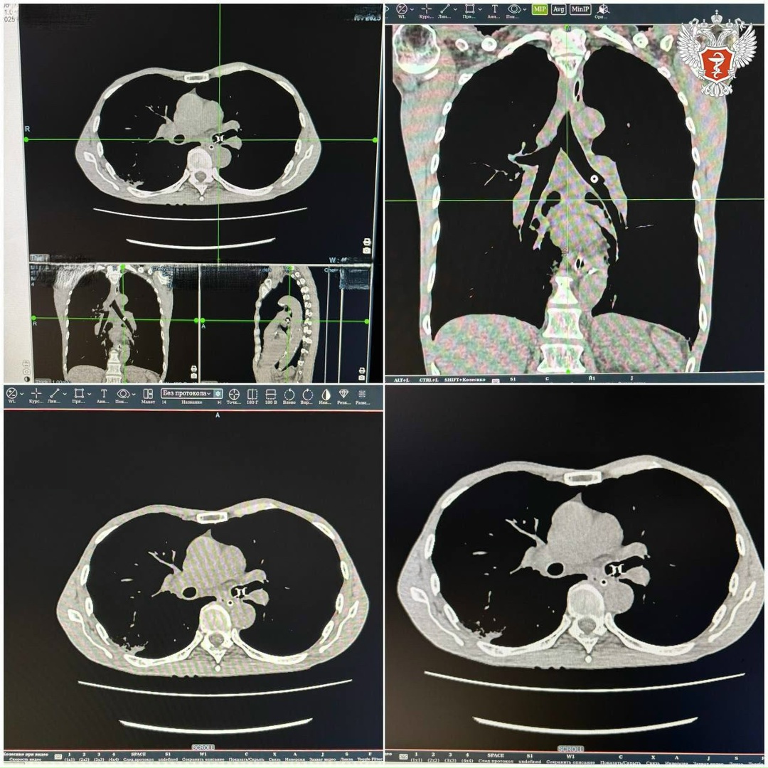 Челябинские врачи спасли пациента с инородным телом в бронхах