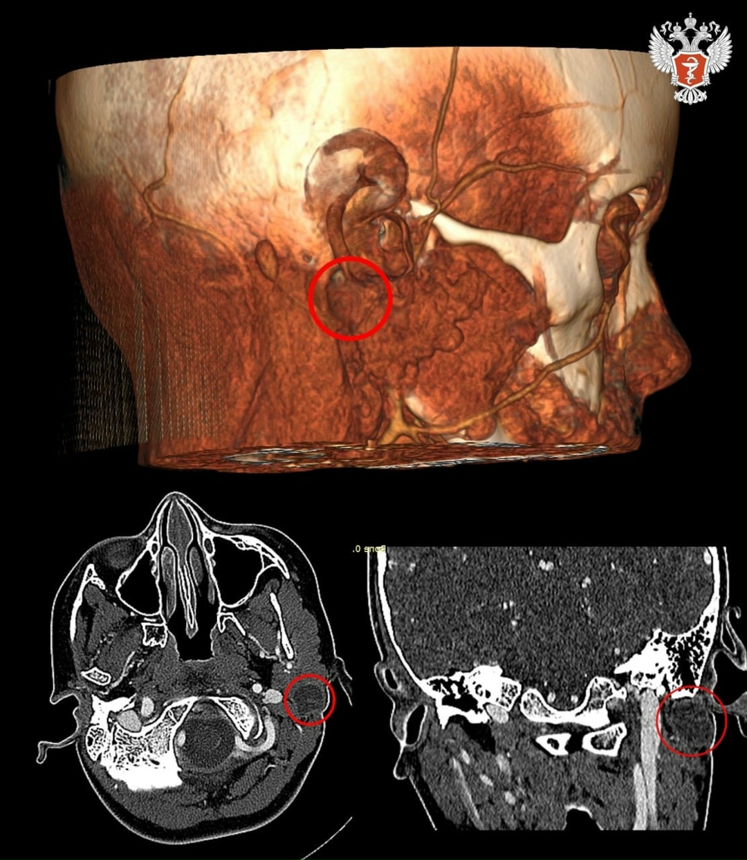 Врачи РДКБ Минздрава России удалили ребенку редчайшее образование за ухом