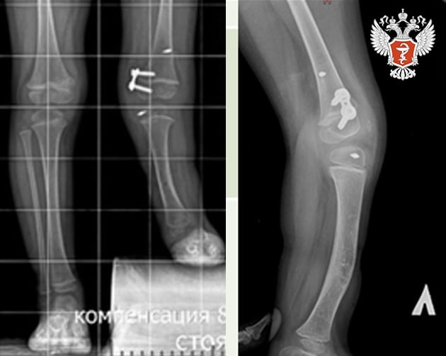 Специалисты федерального центра Минздрава России внедрили новый метод лечения врожденной патологии костей у детей