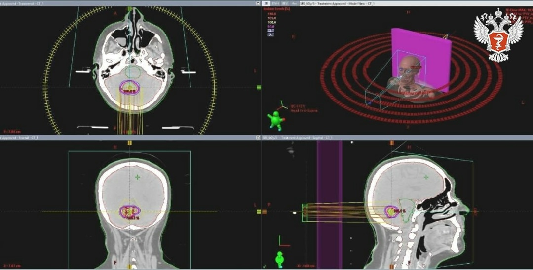 Псковские врачи применили щадящий метод лечения рака молочной железы IV стадии
