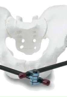 Воронежские травматологи сохранили женщине возможность ходить после тяжёлой травмы на тюбинге