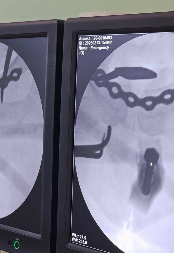 Воронежские травматологи сохранили женщине возможность ходить после тяжёлой травмы на тюбинге