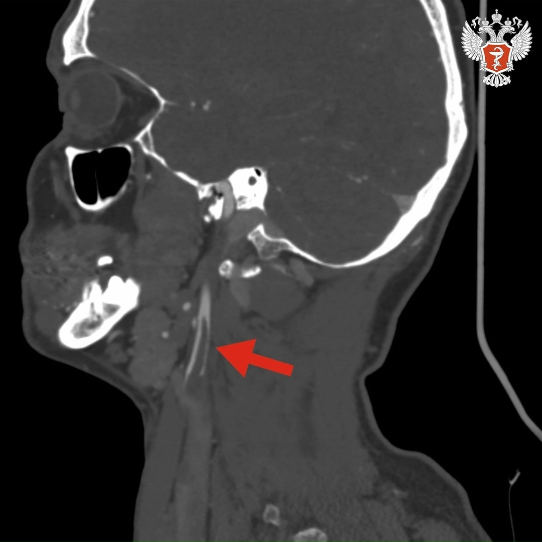 Врачи Смоленской области удалили пациенту тромб, провоцирующий поражение головного мозга