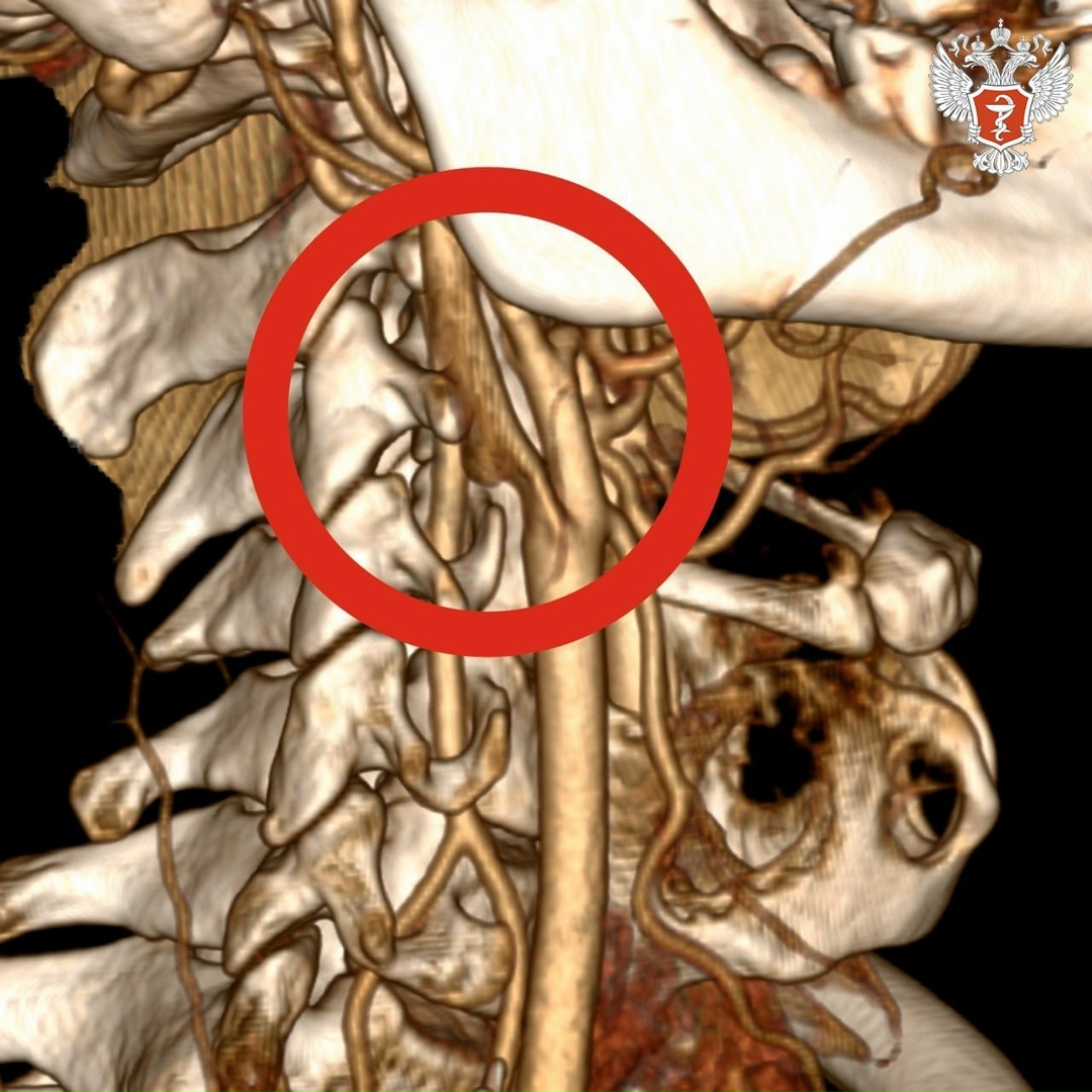 Врачи Смоленской области удалили пациенту тромб, провоцирующий поражение головного мозга