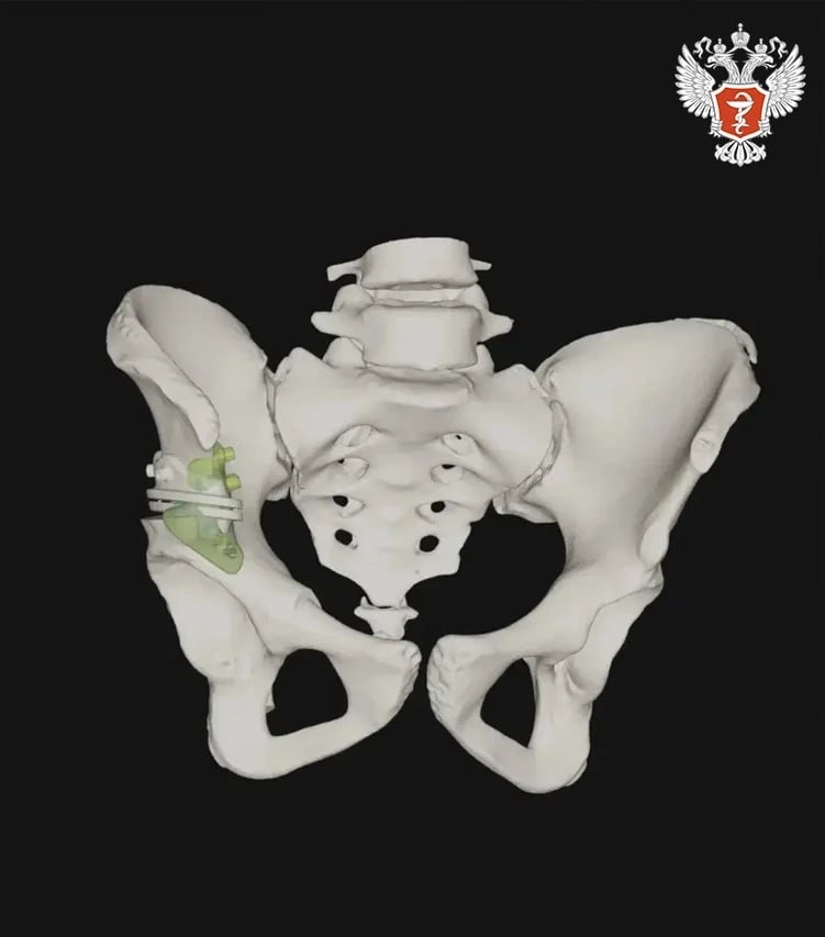 Специалисты федерального центра провели сложную операцию 19-летней пациентке с врожденной патологией тазобедренного сустава