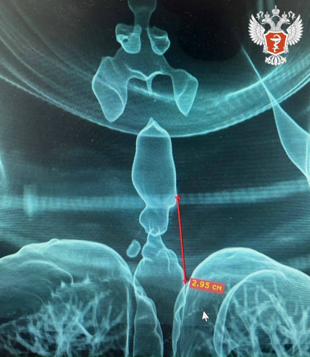 Врачи Удмуртской Республики восстановили пациентке нормальное дыхание, используя 3D-технологии