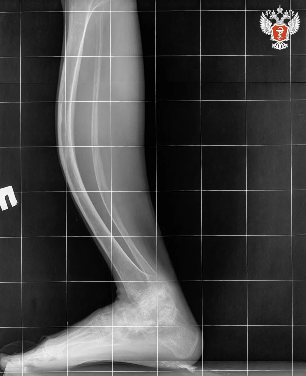 Врачи НМИЦ травматологии и ортопедии им. ак. Г. А. Илизарова Минздрава России ставят на ноги пациентов с «хрустальной болезнью»