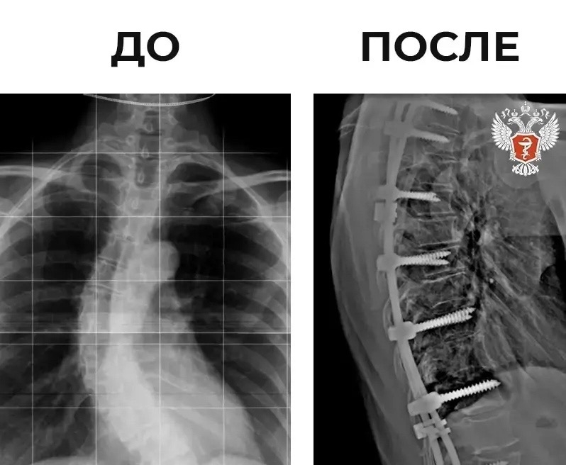 Нейрохирурги Ярославской области исправили пациентке тяжелый вид сколиоза