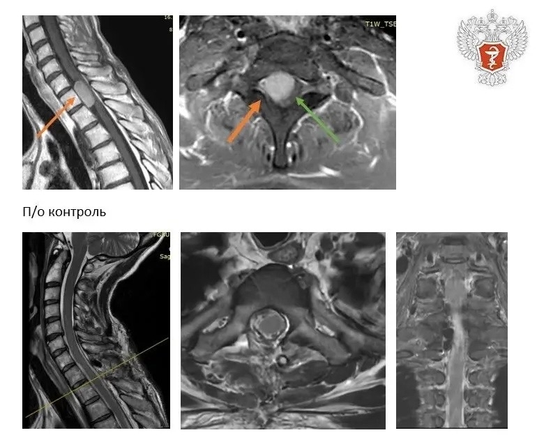 Врачи федерального центра Минздрава России удалили пациентке опухоль спинного мозга, которая нарушала двигательную функцию ног