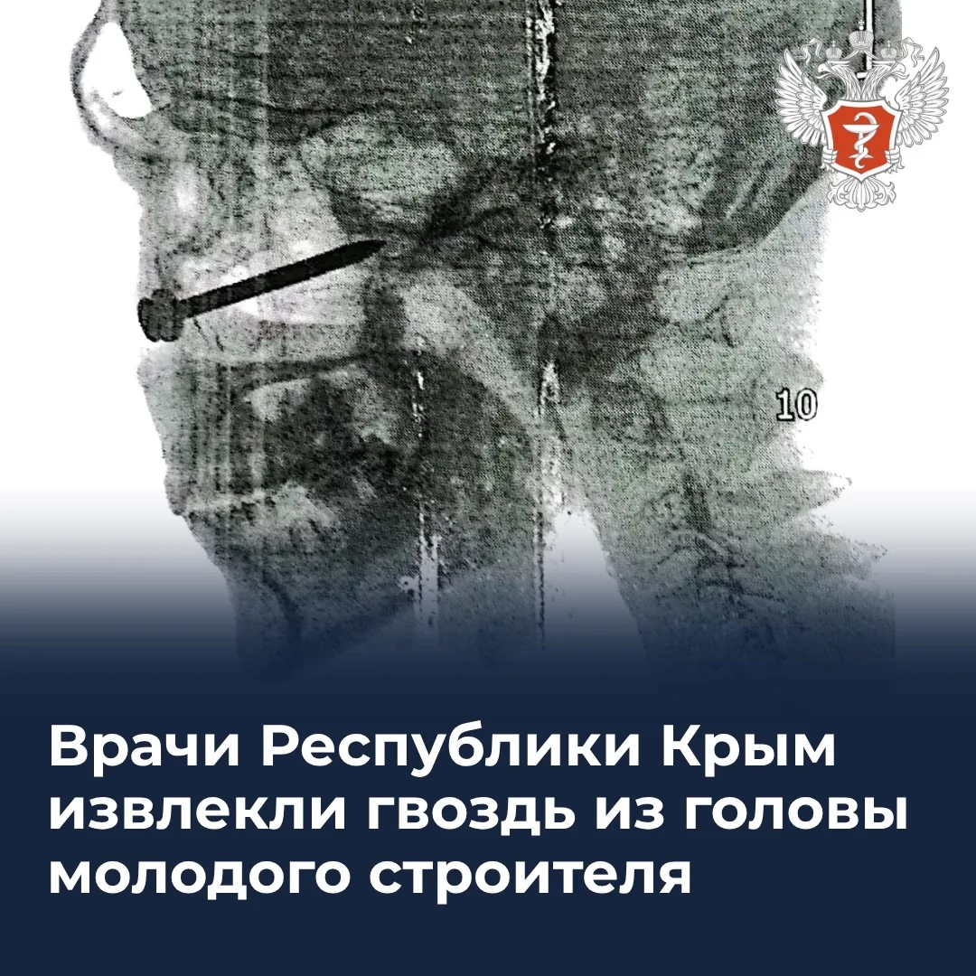  Врачи Республики Крым извлекли гвоздь из головы пациента