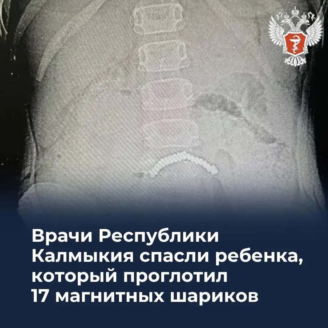 Врачи Республики Калмыкия спасли ребенка, который проглотил 17 магнитных шариков