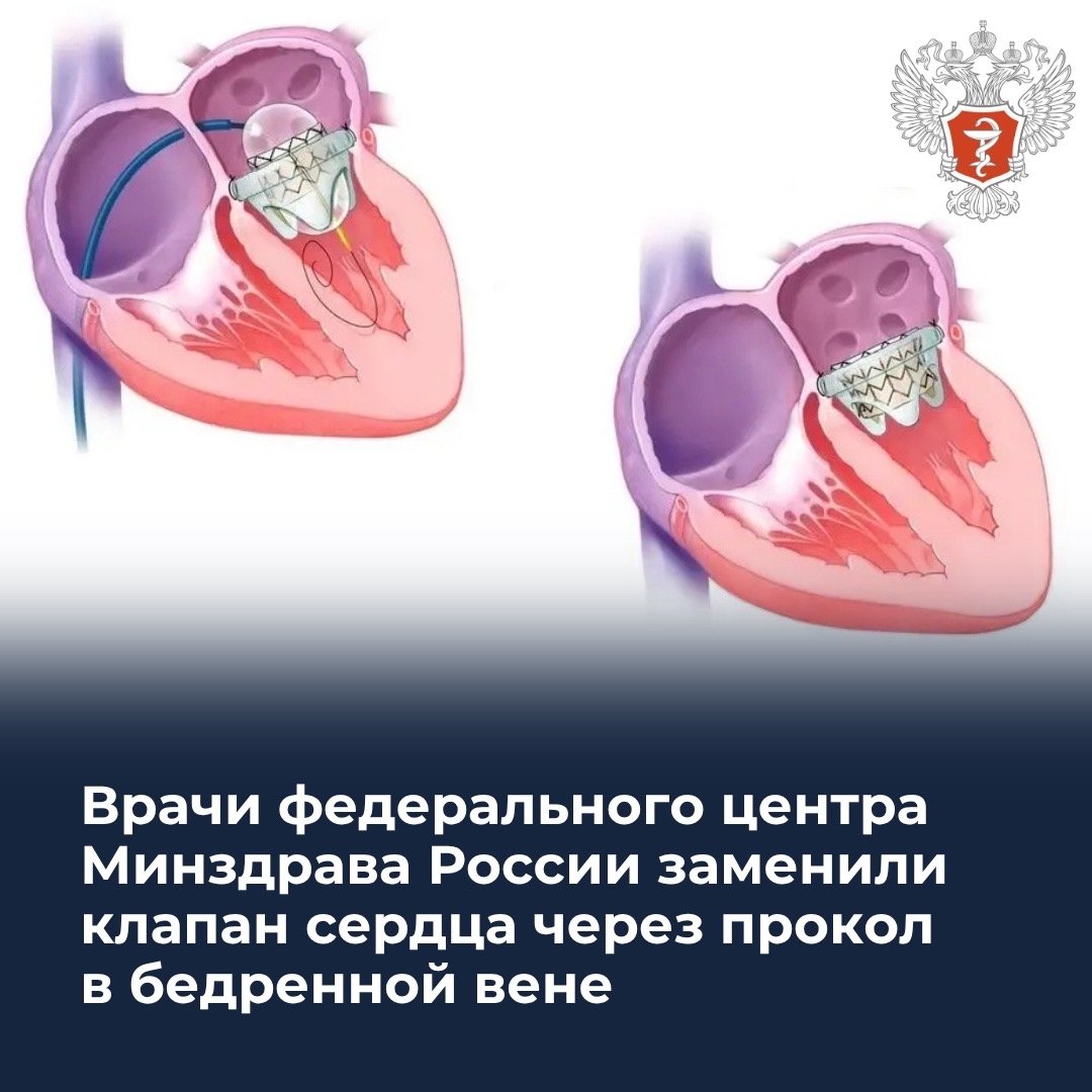 Врачи федерального центра Минздрава России заменили клапан сердца через прокол в бедренной вене