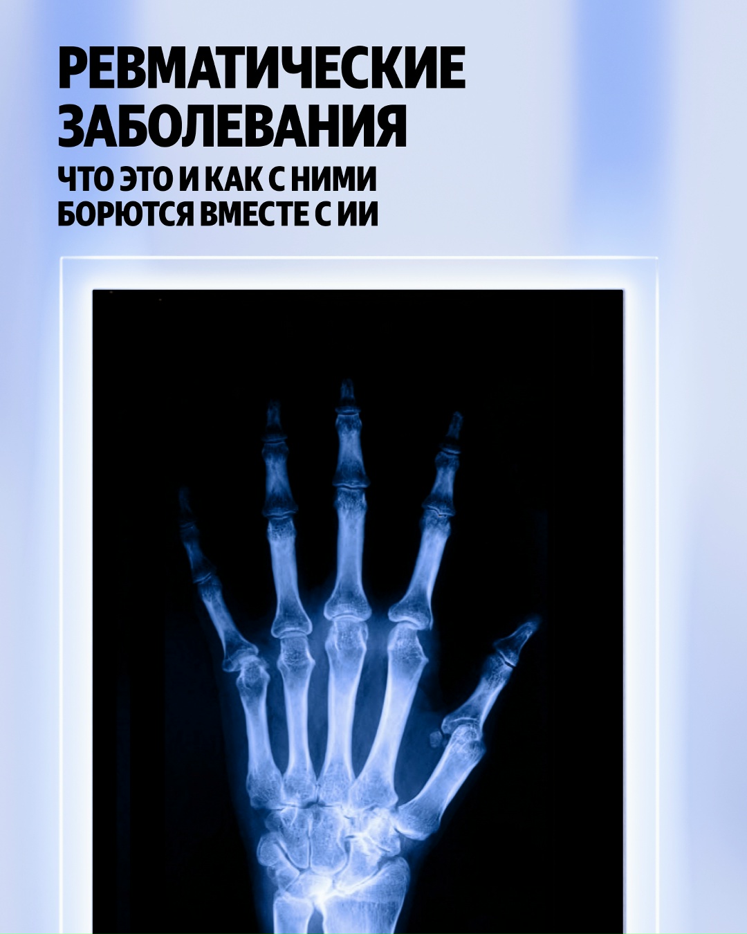 В России 70 тысяч детей с ревматическими заболеваниями. Лечение стоит дорого, а специалисты в регионах не всегда доступны