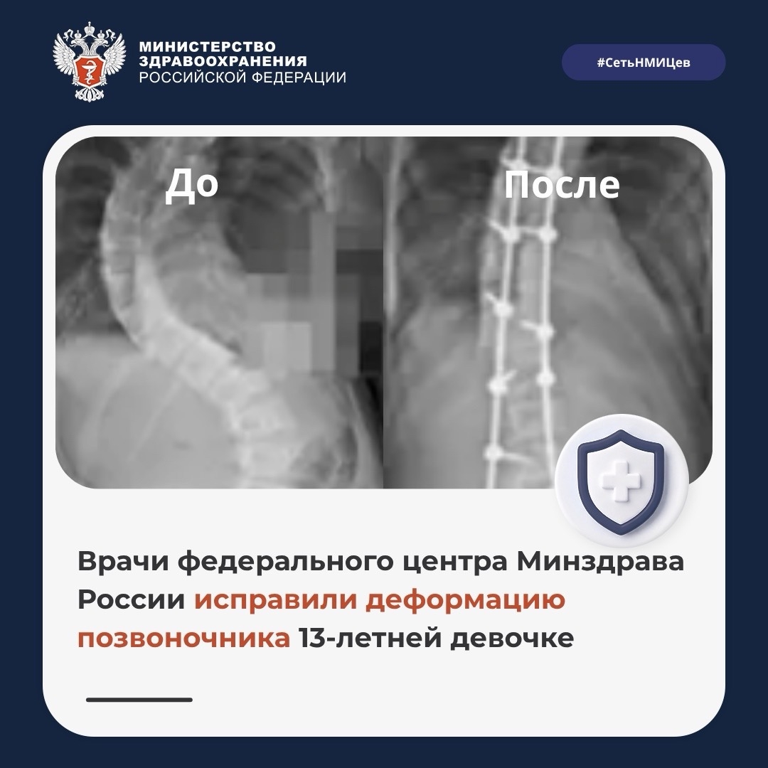 Врачи федерального центра Минздрава России исправили деформацию позвоночника 13-летней девочке